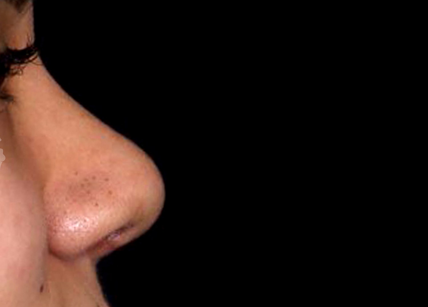 Rhinoplasty Before & After