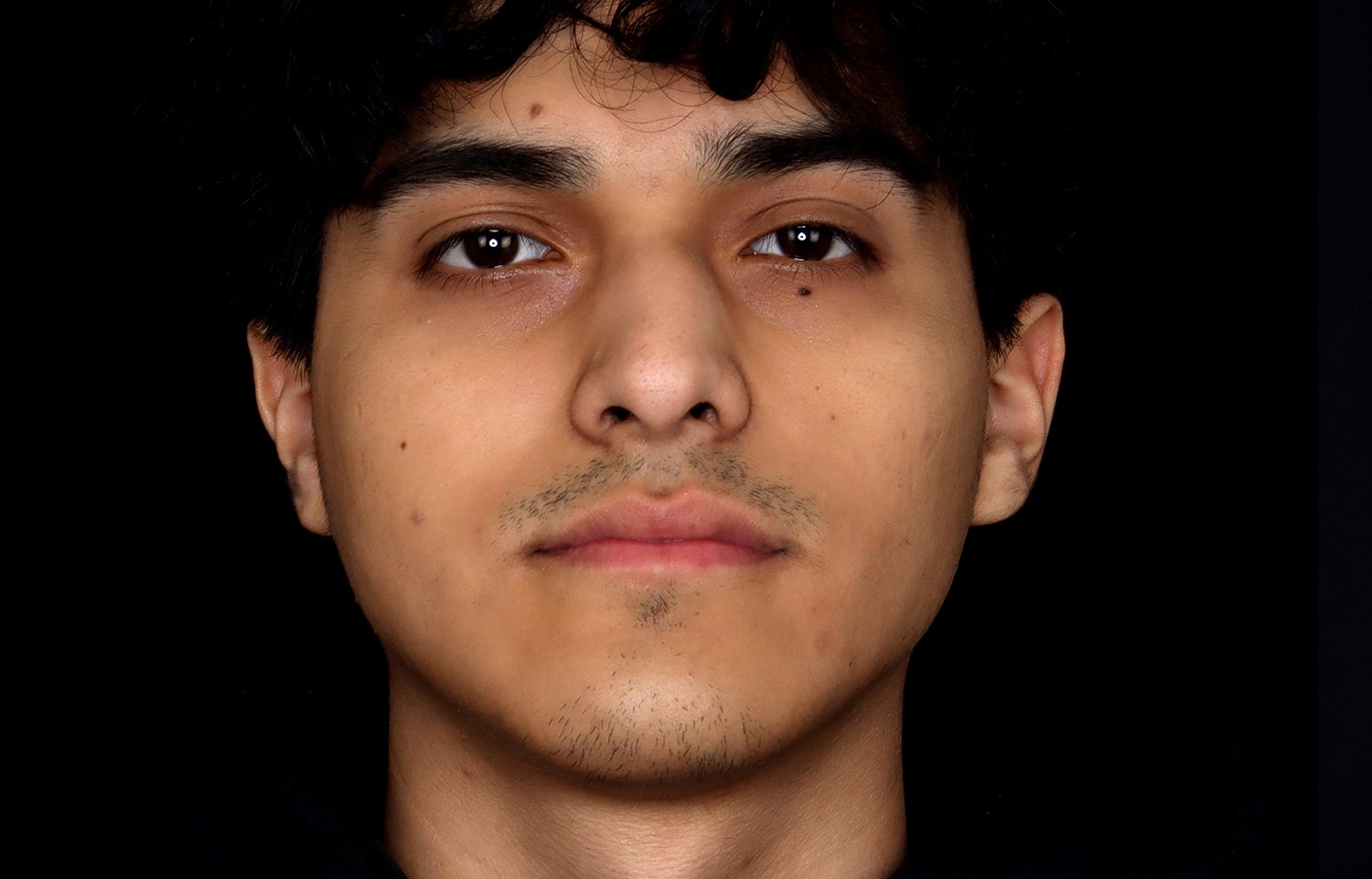 Rhinoplasty Before & After