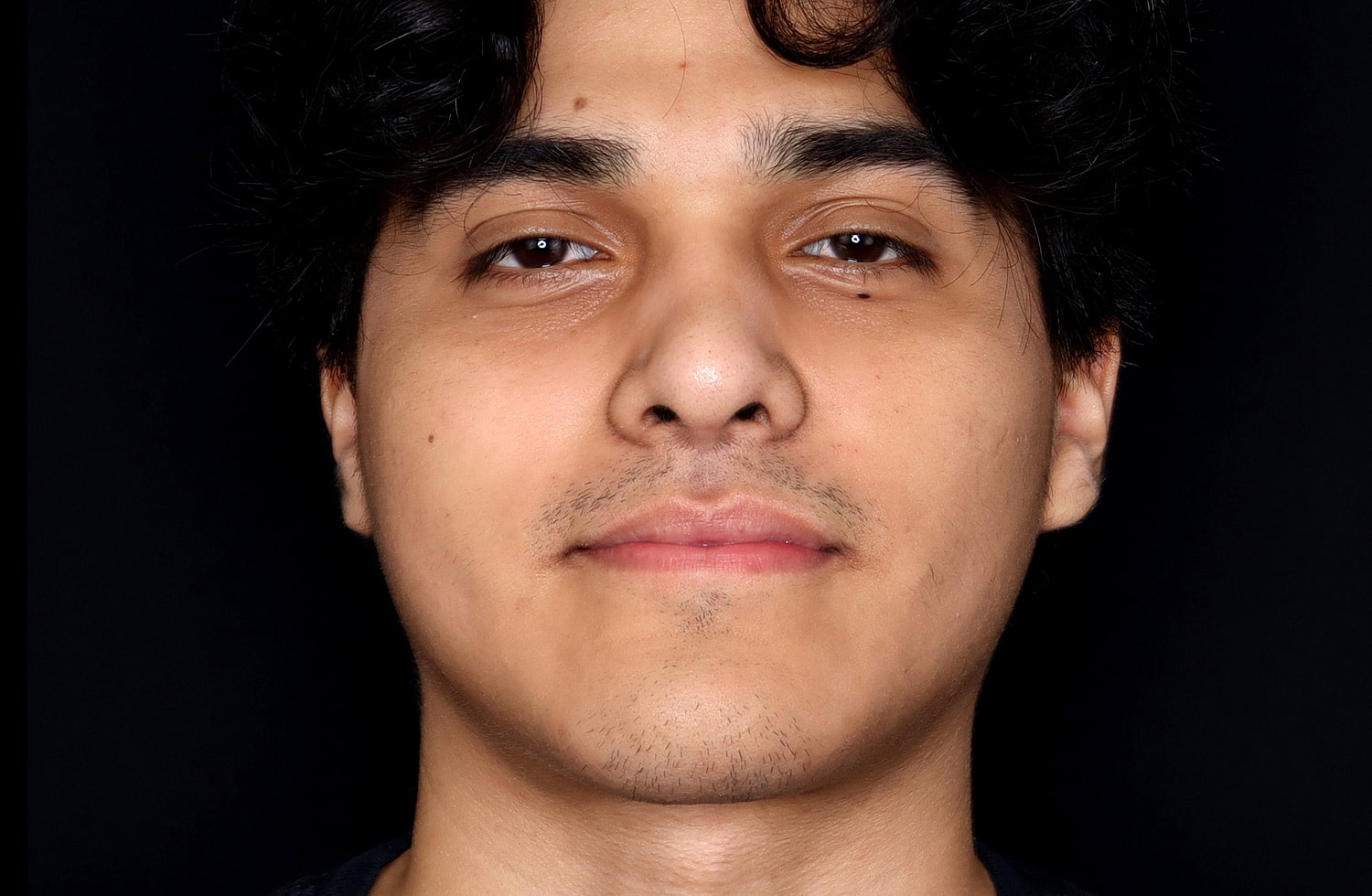 Rhinoplasty Before & After
