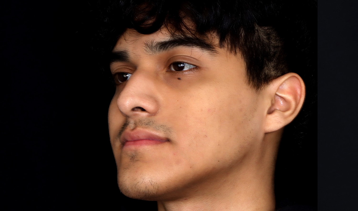 Rhinoplasty Before & After