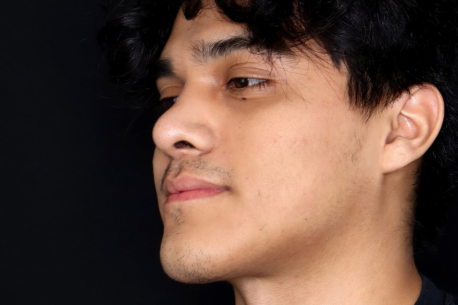Rhinoplasty Before & After