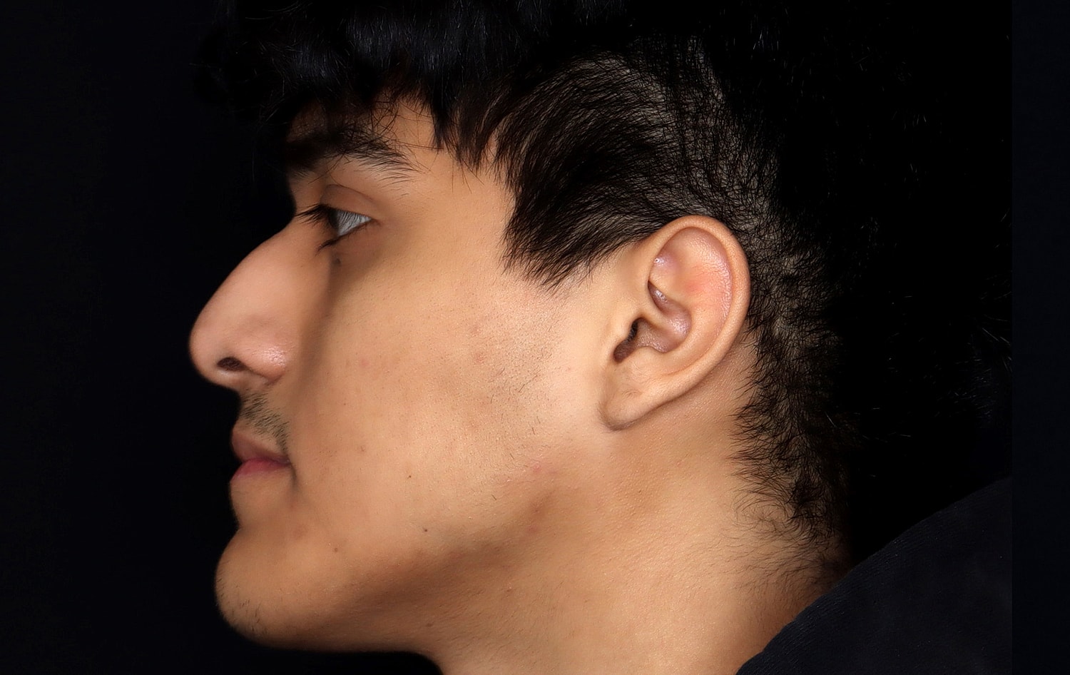 Rhinoplasty Before & After