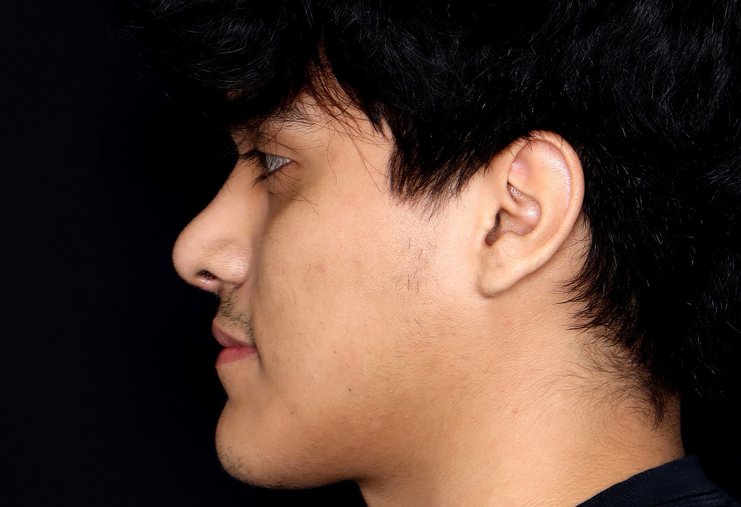Rhinoplasty Before & After
