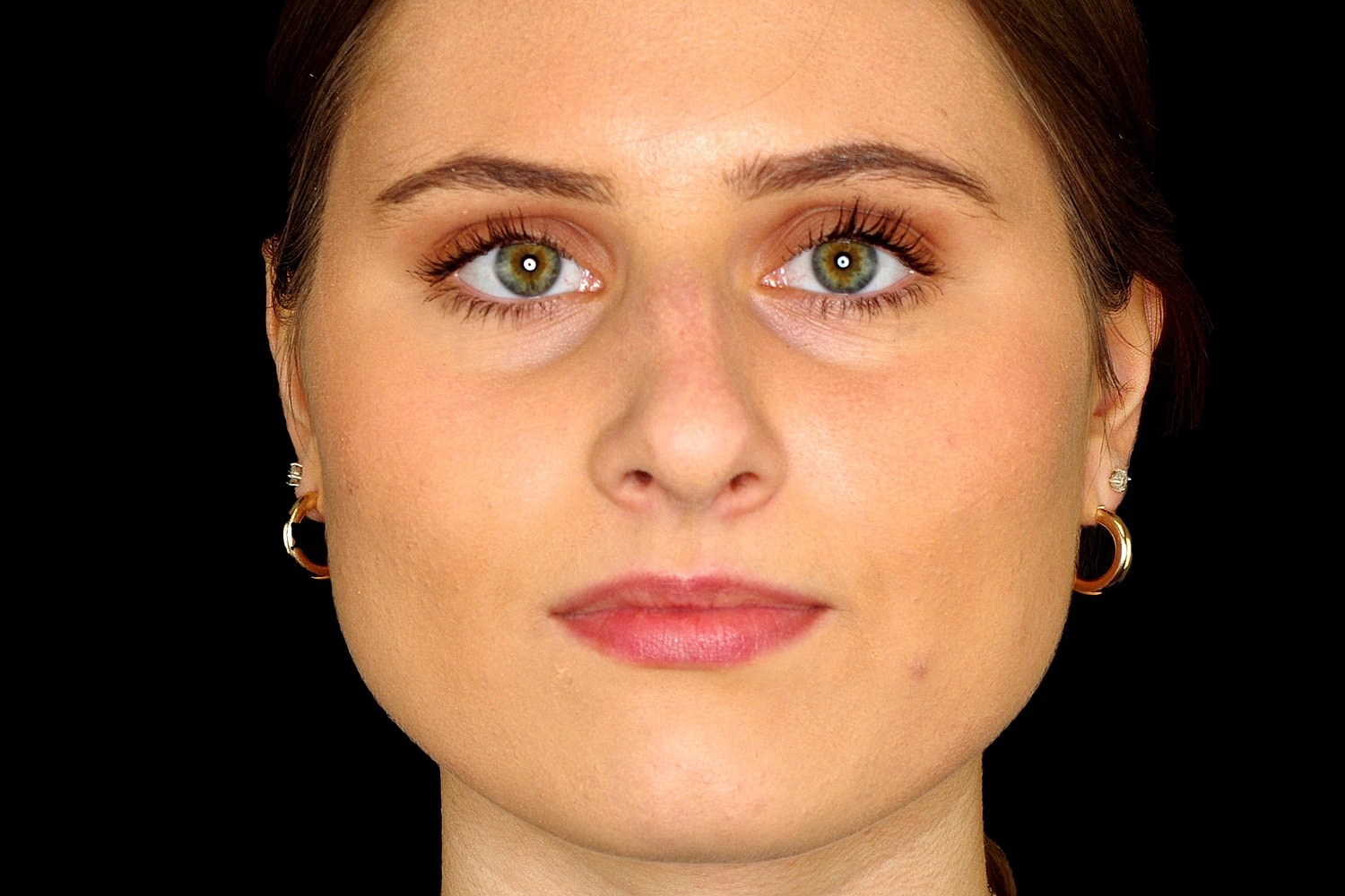 Rhinoplasty Before & After