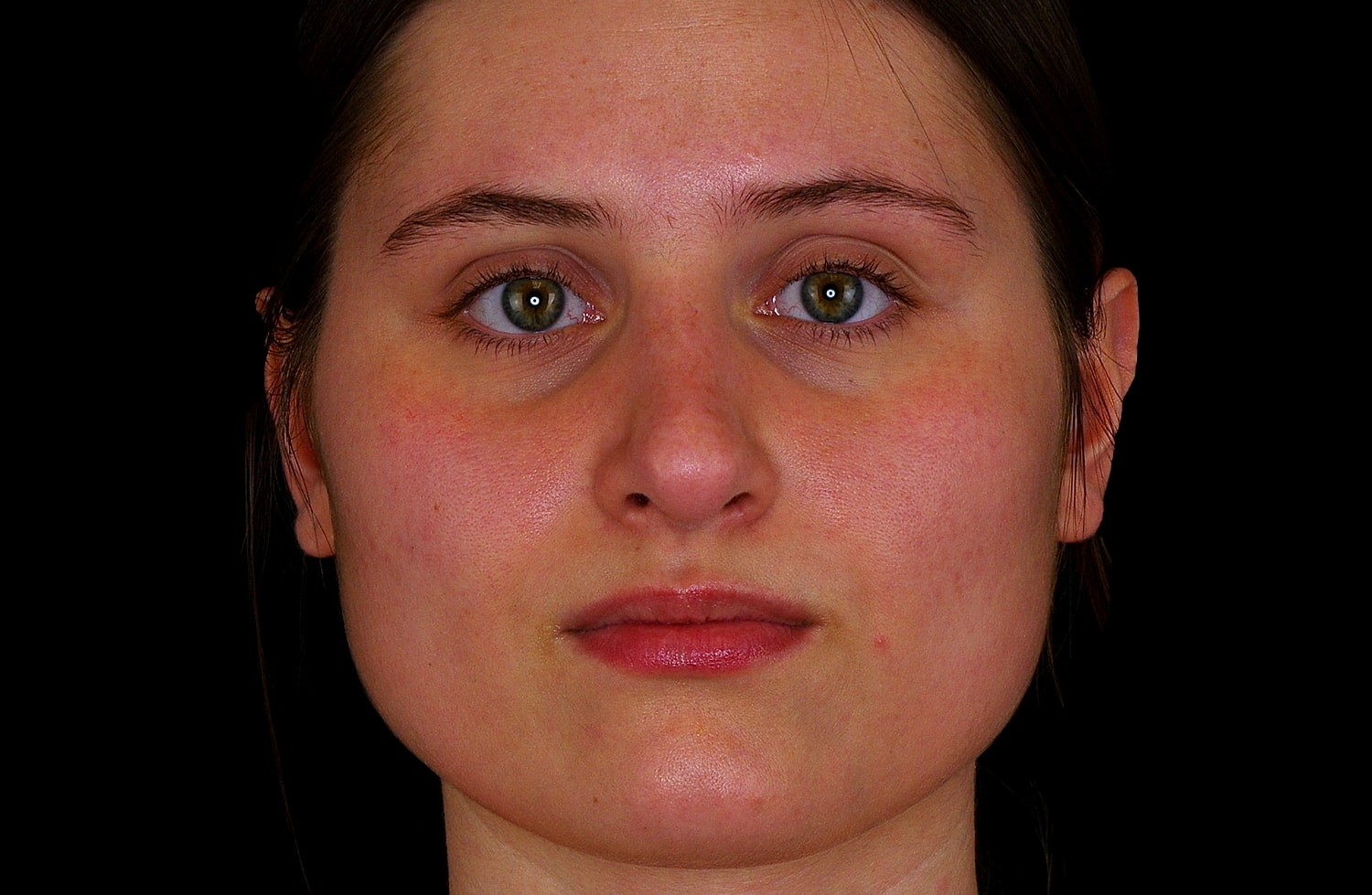 Rhinoplasty Before & After
