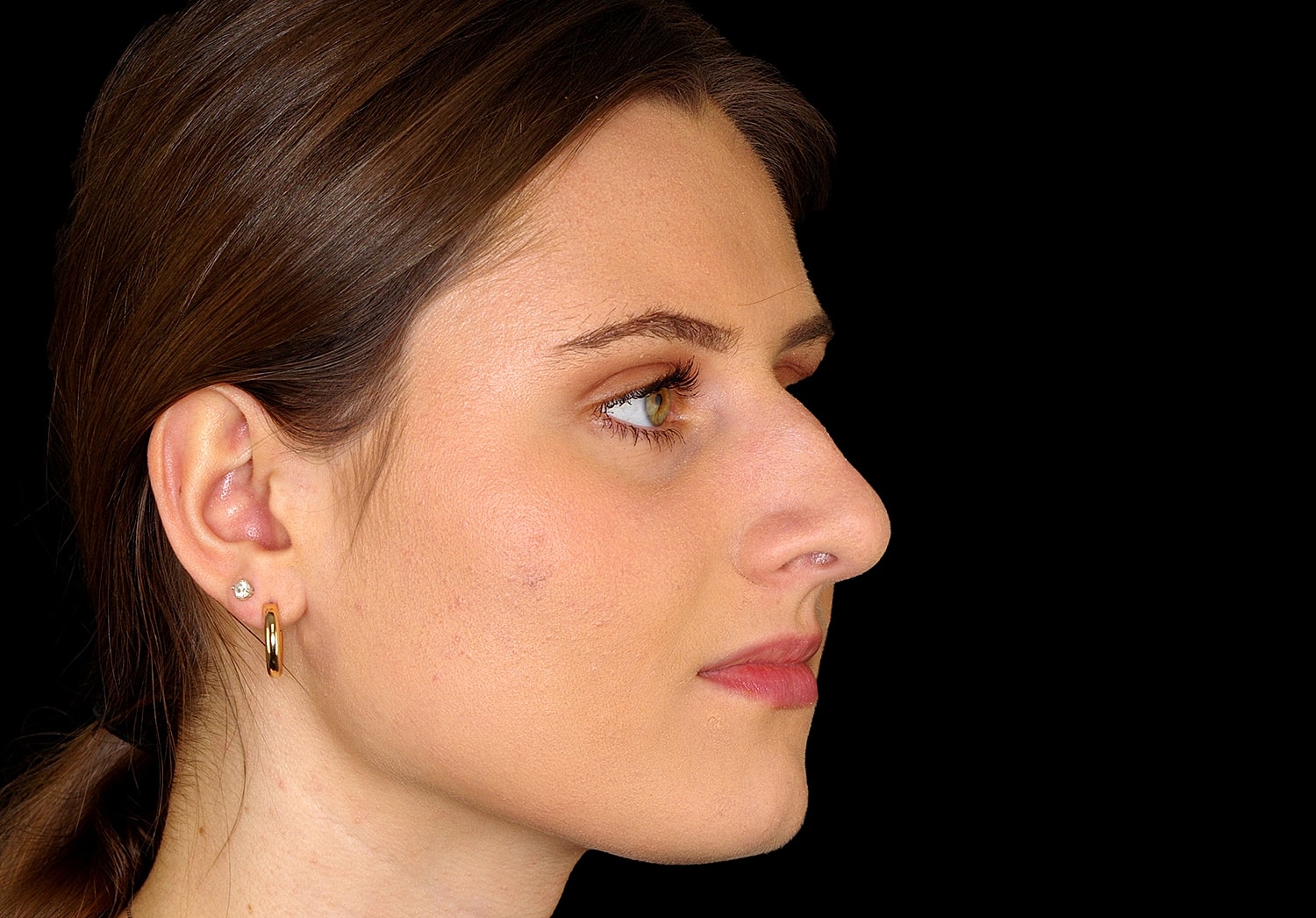 Rhinoplasty Before & After