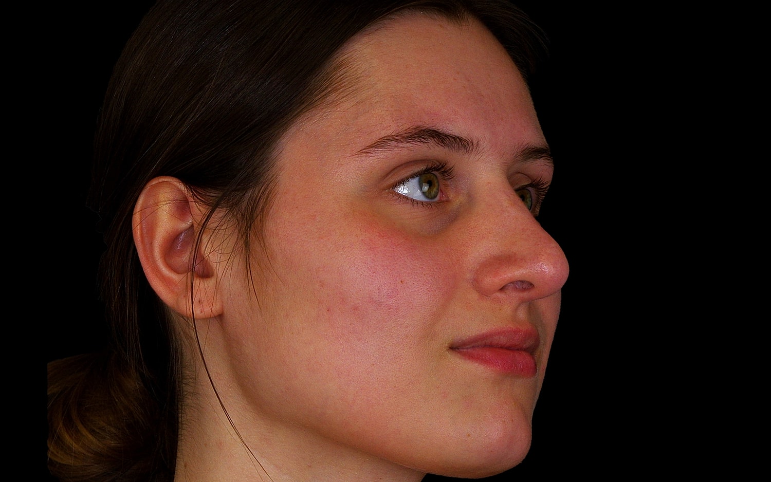 Rhinoplasty Before & After