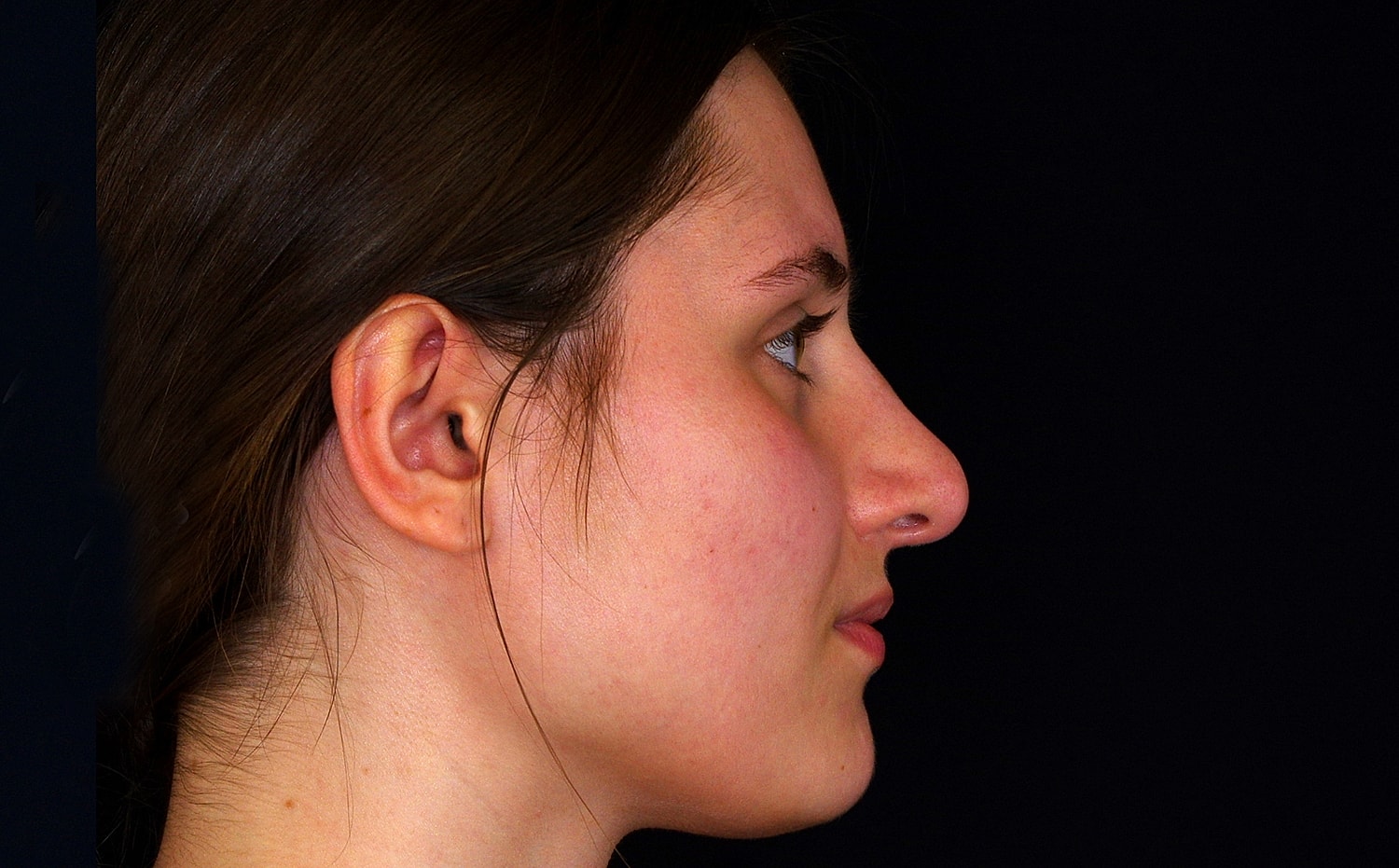 Rhinoplasty Before & After