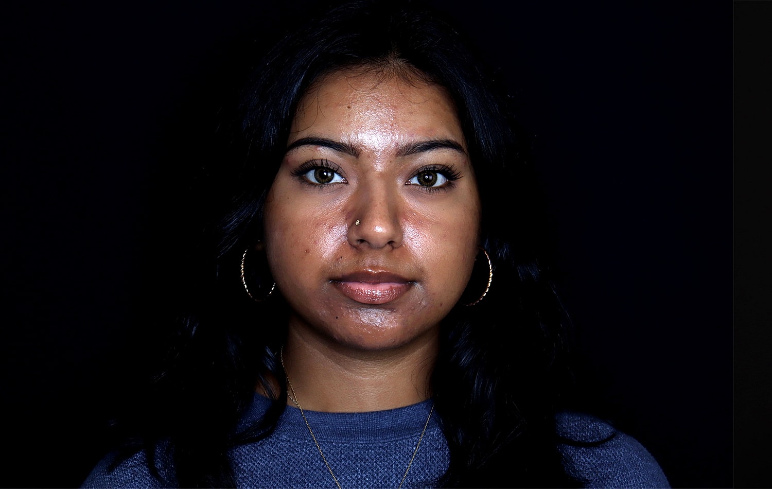 Rhinoplasty Before & After