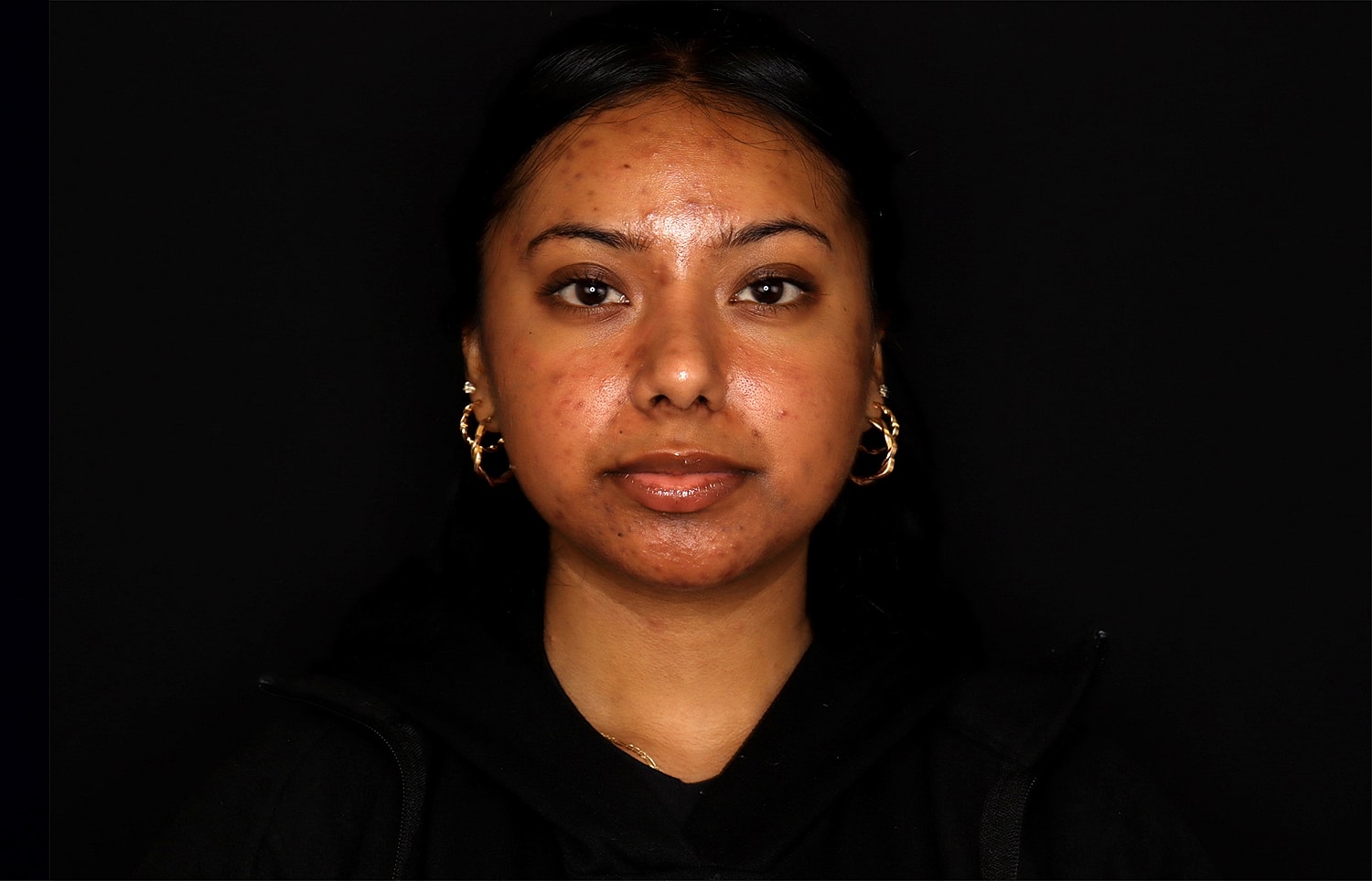 Rhinoplasty Before & After