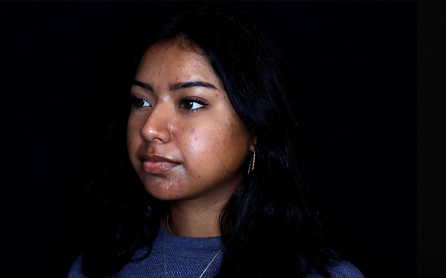 Rhinoplasty Before & After