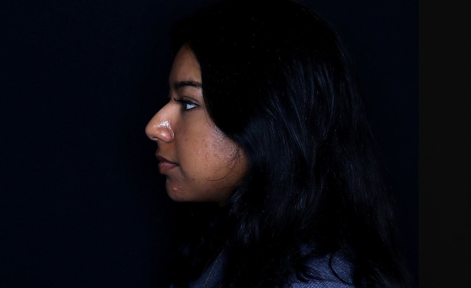 Rhinoplasty Before & After