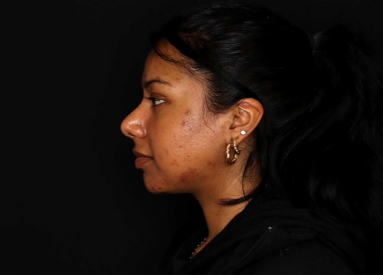 Rhinoplasty Before & After
