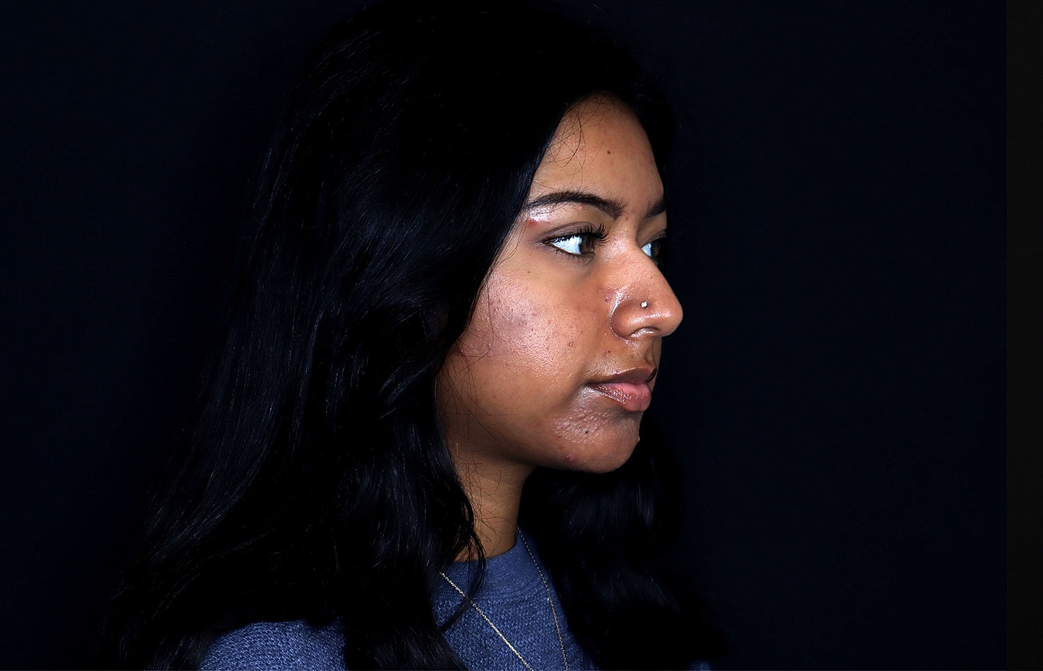 Rhinoplasty Before & After