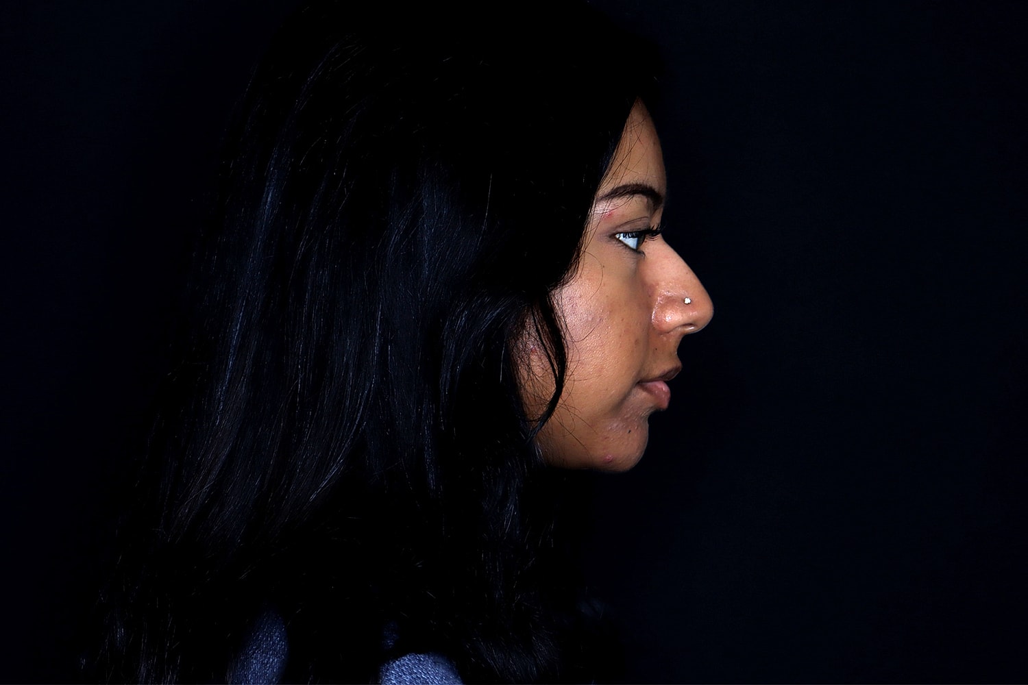 Rhinoplasty Before & After