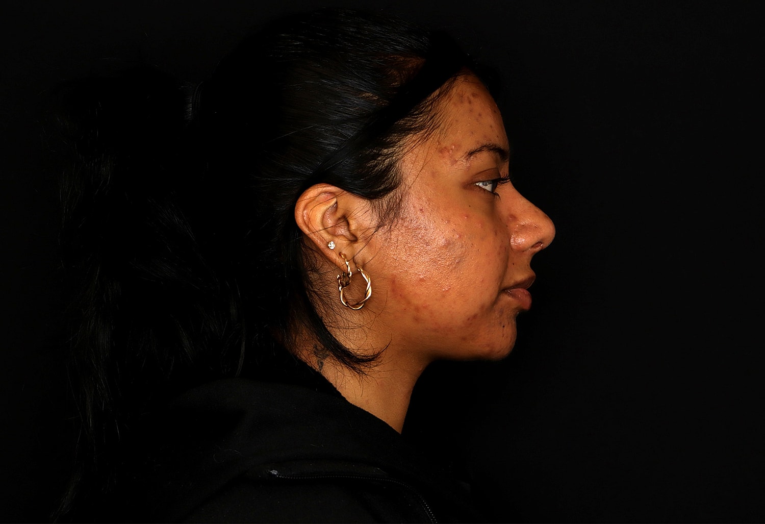 Rhinoplasty Before & After