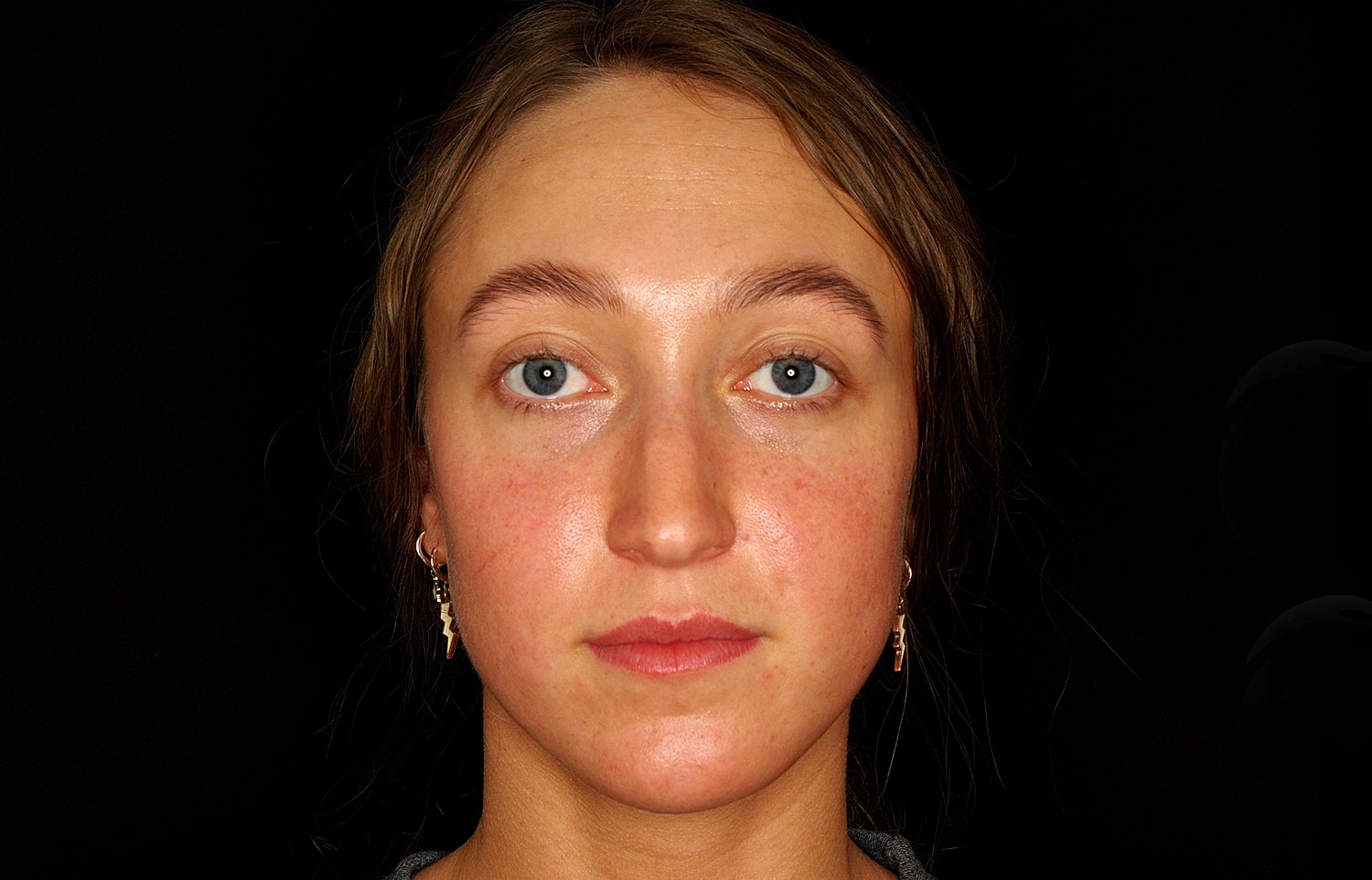 Rhinoplasty Before & After