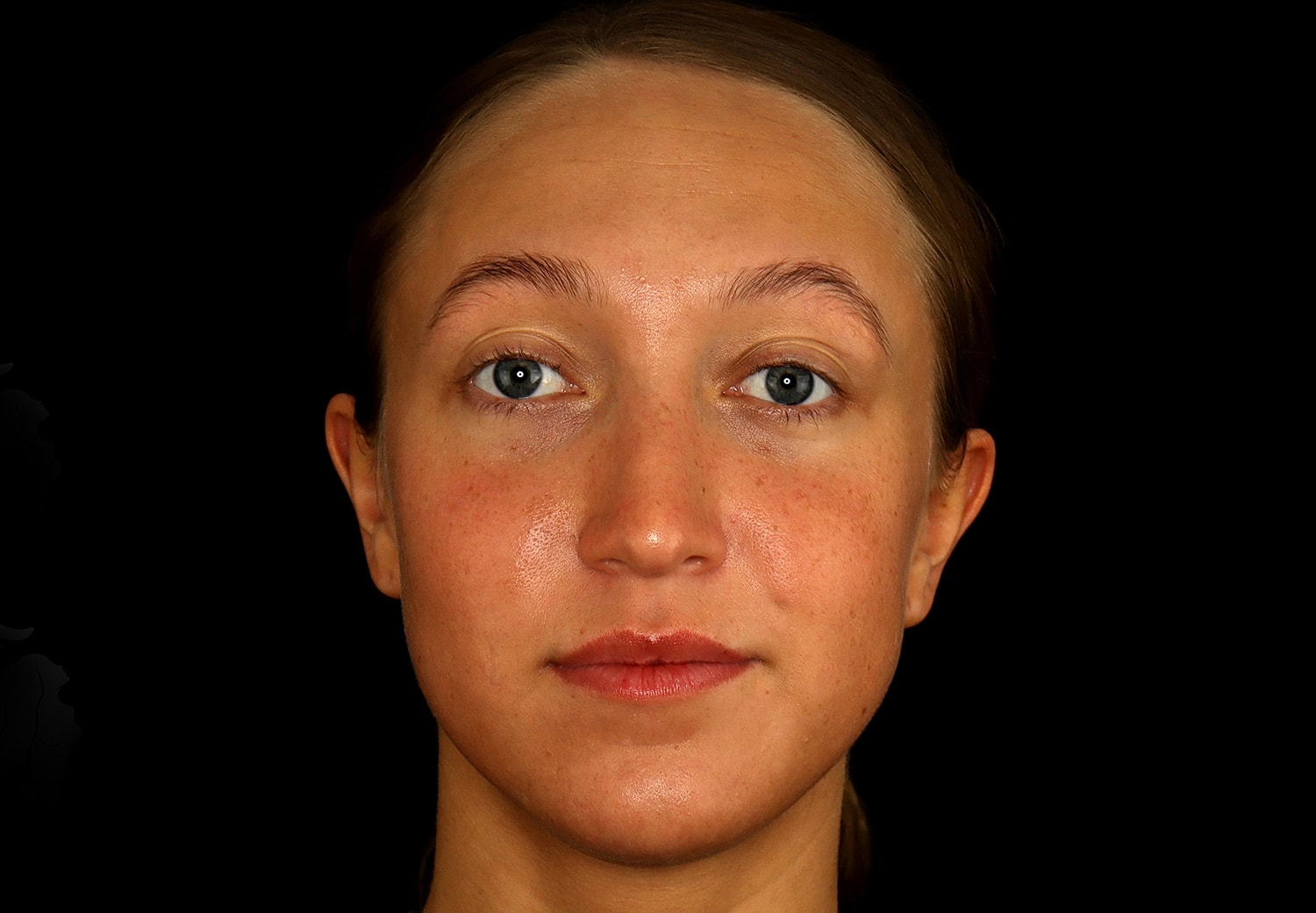Rhinoplasty Before & After