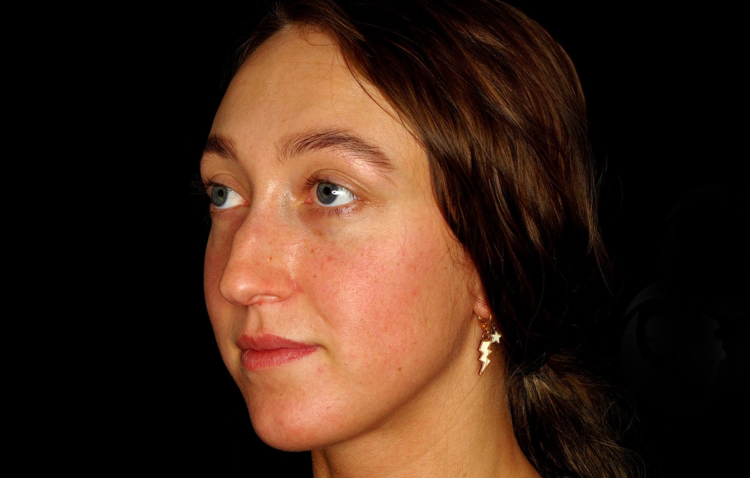 Rhinoplasty Before & After