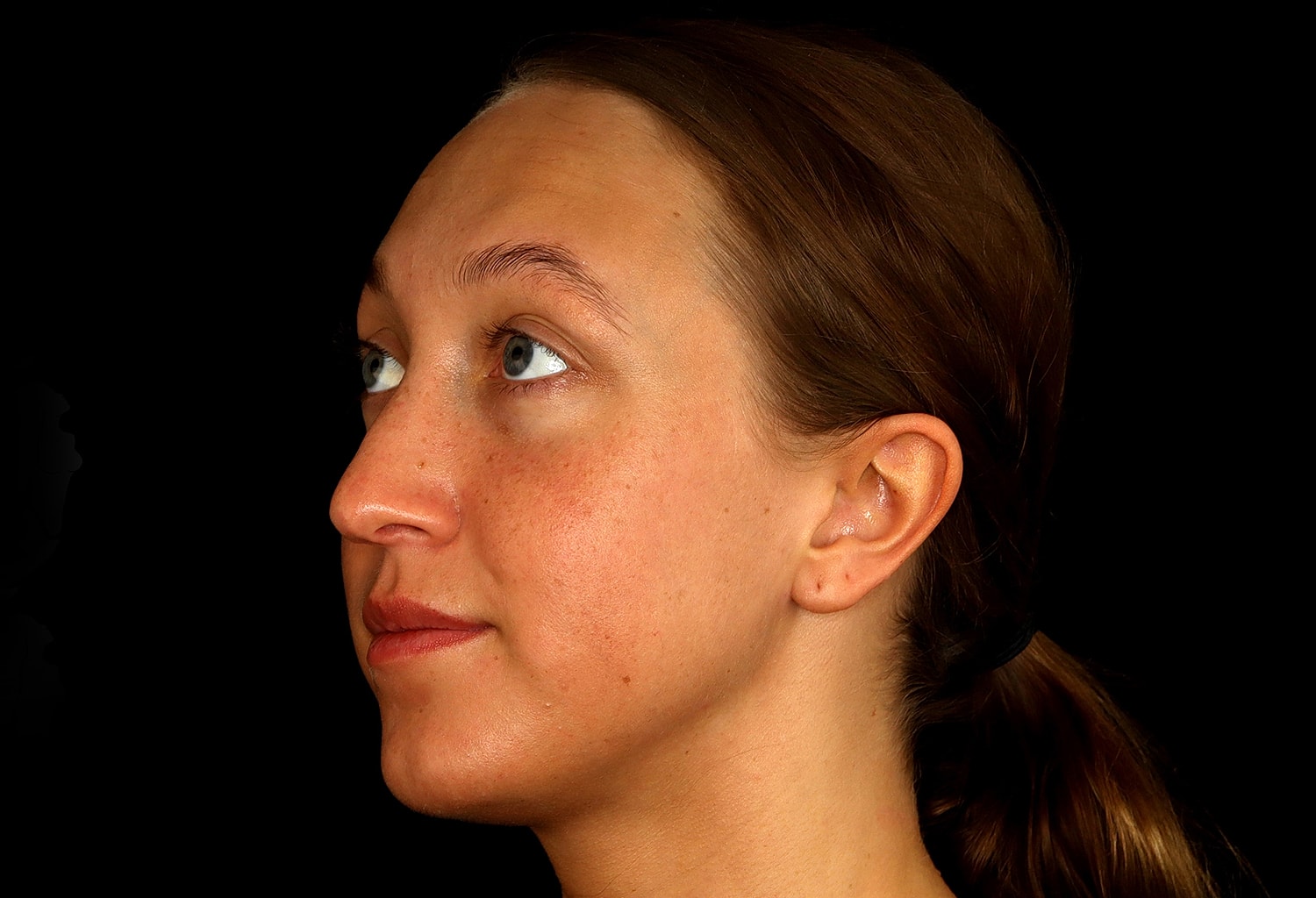 Rhinoplasty Before & After