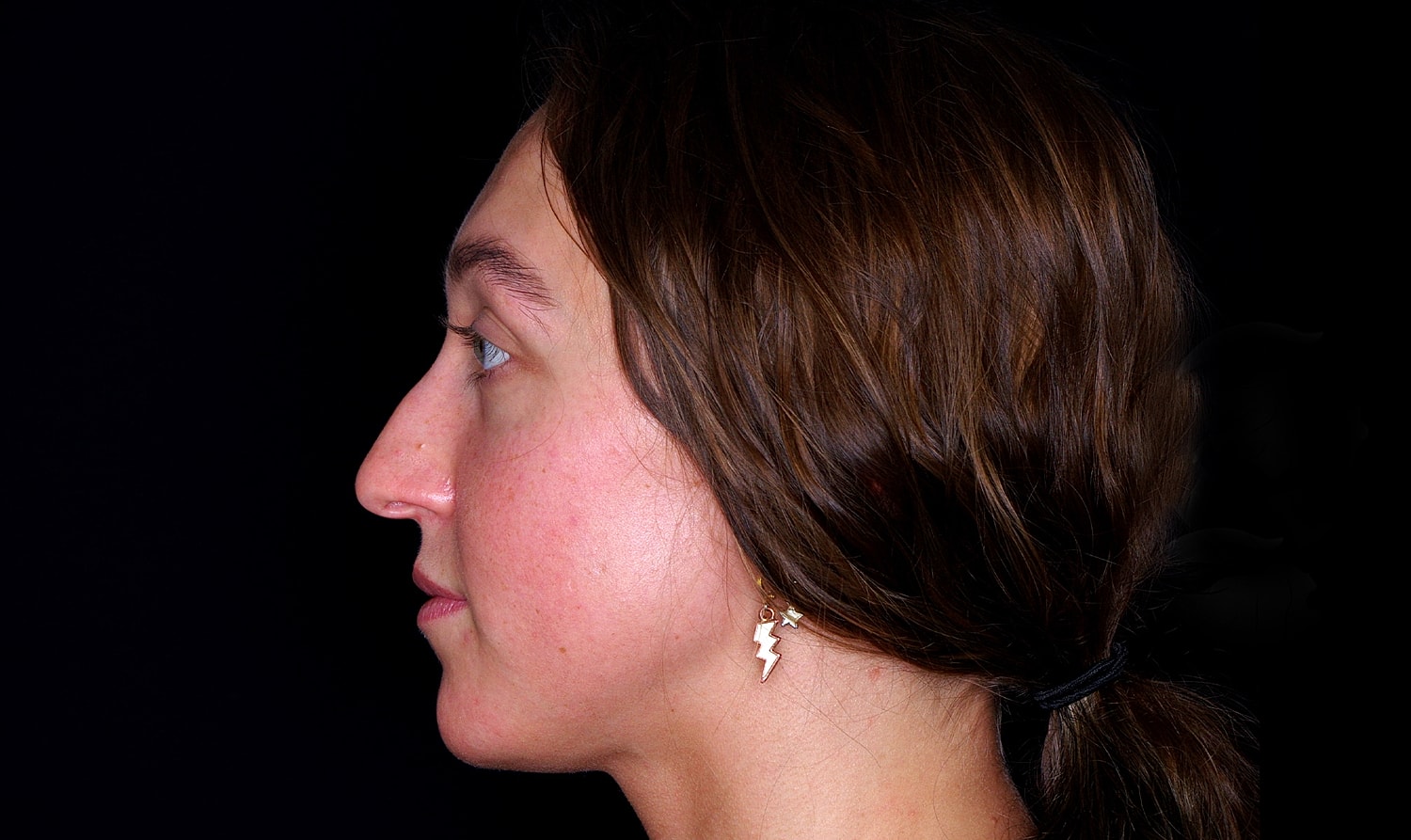 Rhinoplasty Before & After