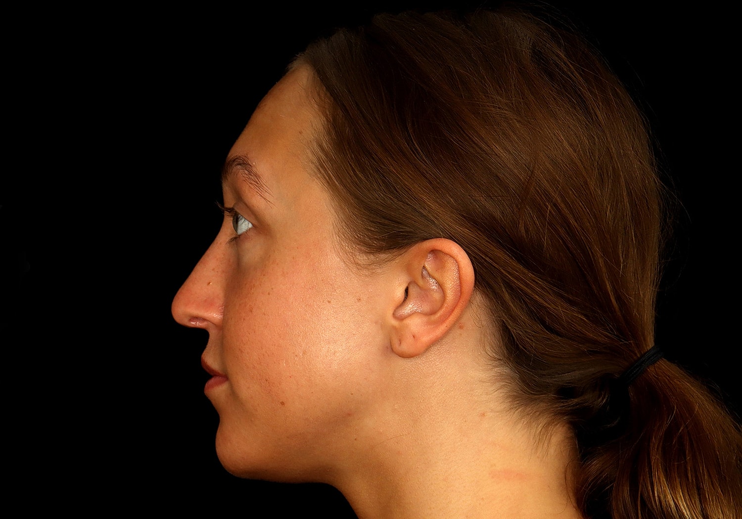 Rhinoplasty Before & After