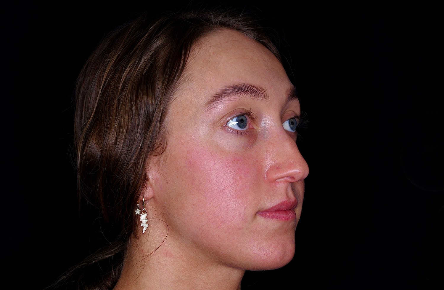 Rhinoplasty Before & After