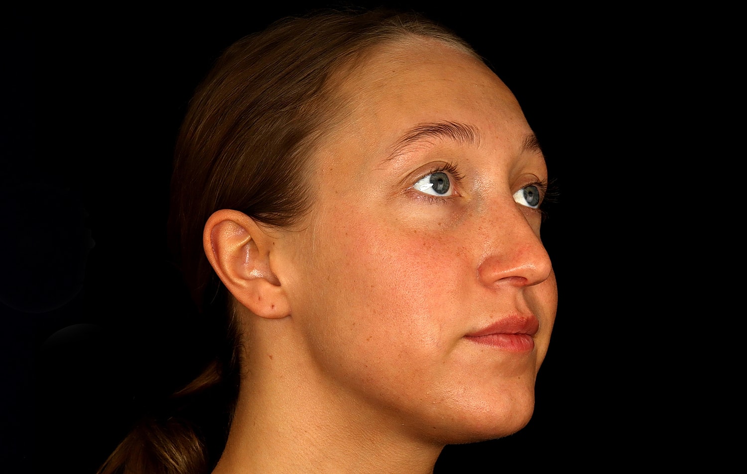 Rhinoplasty Before & After