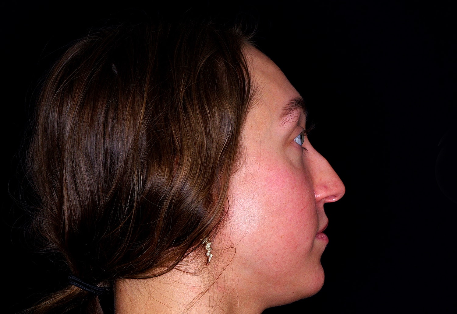 Rhinoplasty Before & After