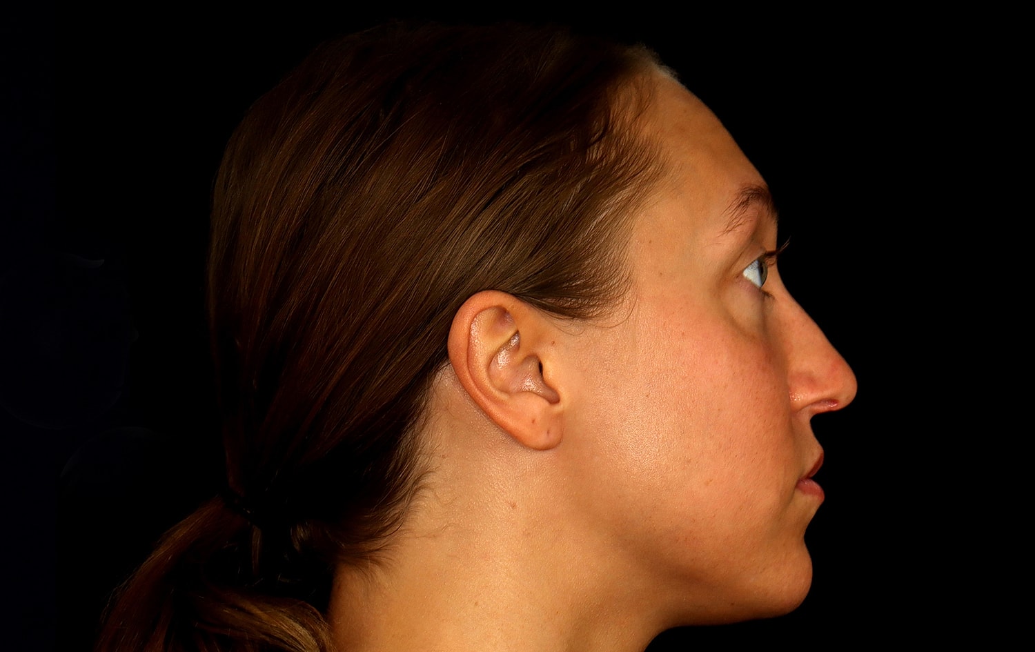 Rhinoplasty Before & After