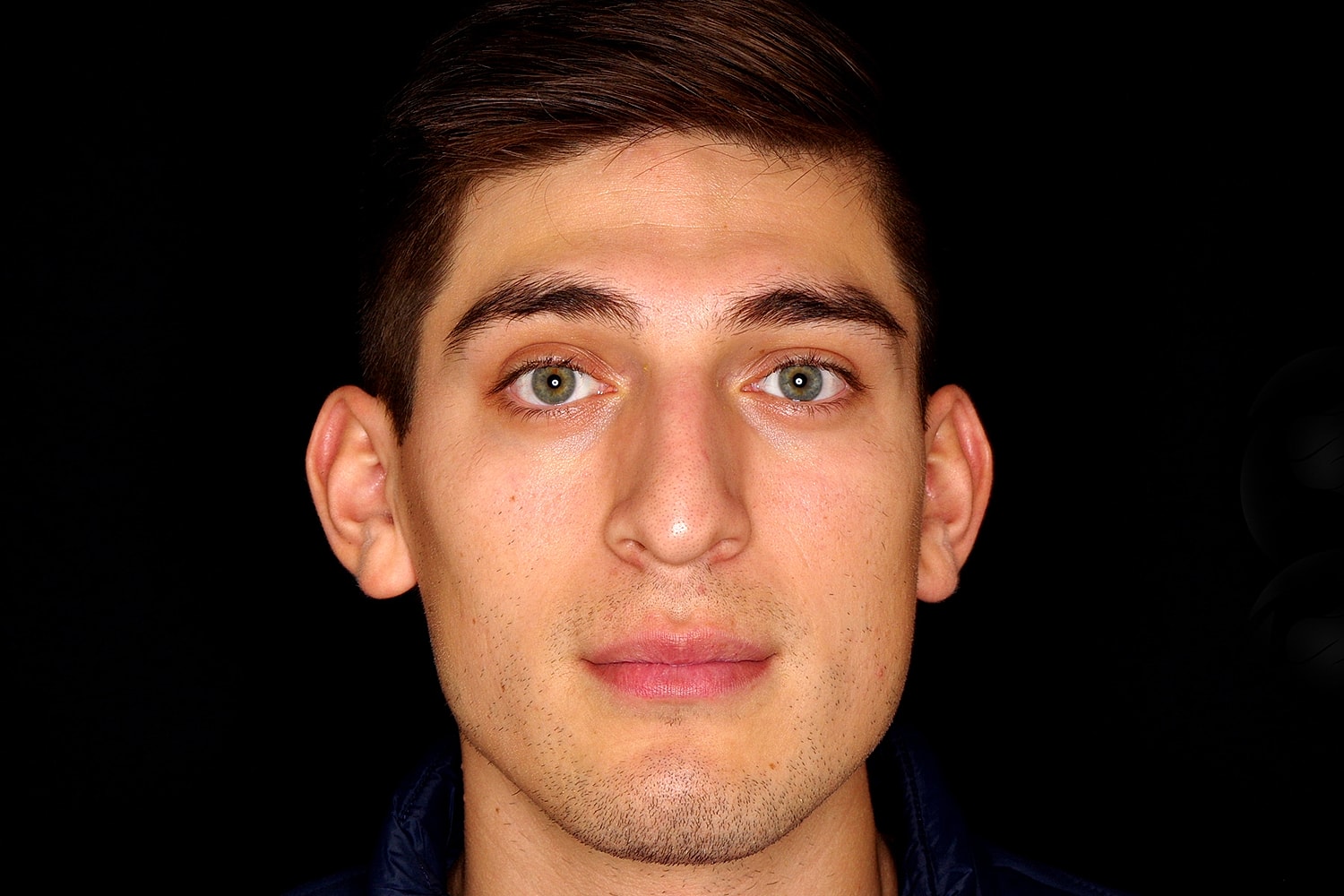 Rhinoplasty Before & After