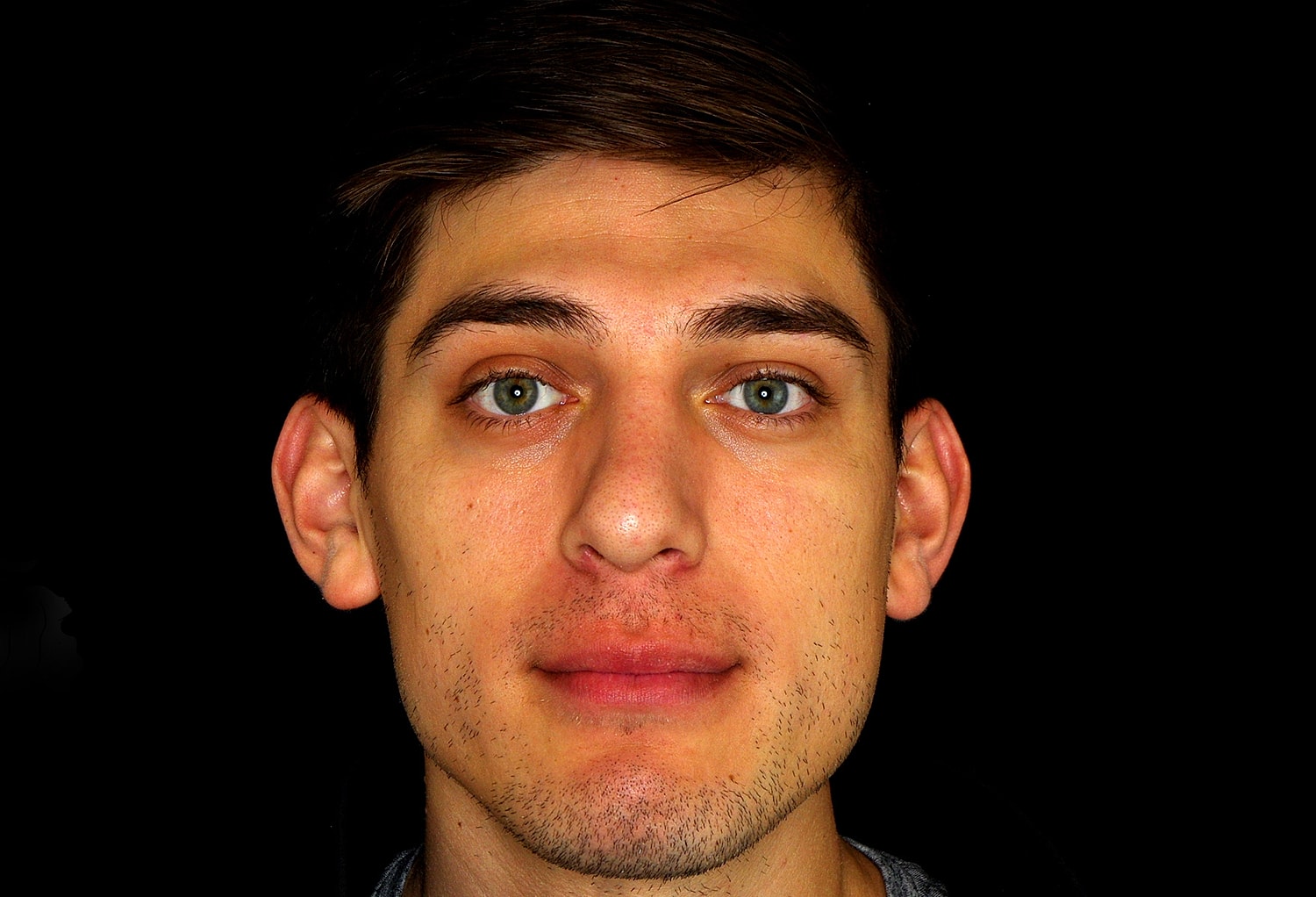 Rhinoplasty Before & After