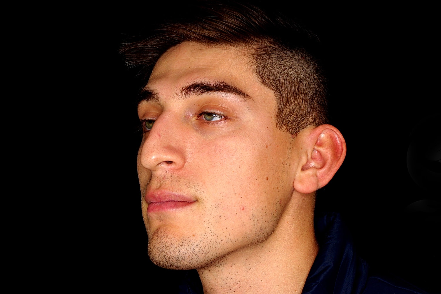 Rhinoplasty Before & After