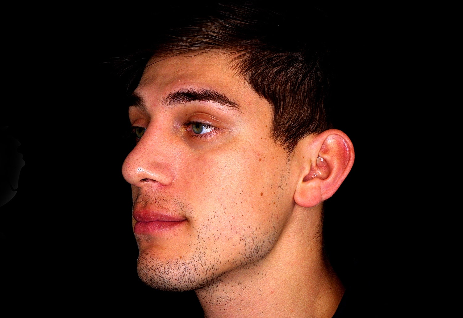 Rhinoplasty Before & After