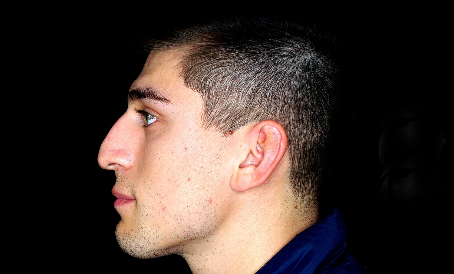 Rhinoplasty Before & After