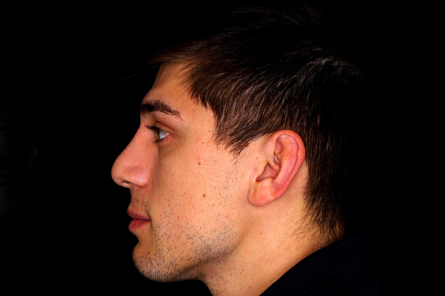 Rhinoplasty Before & After