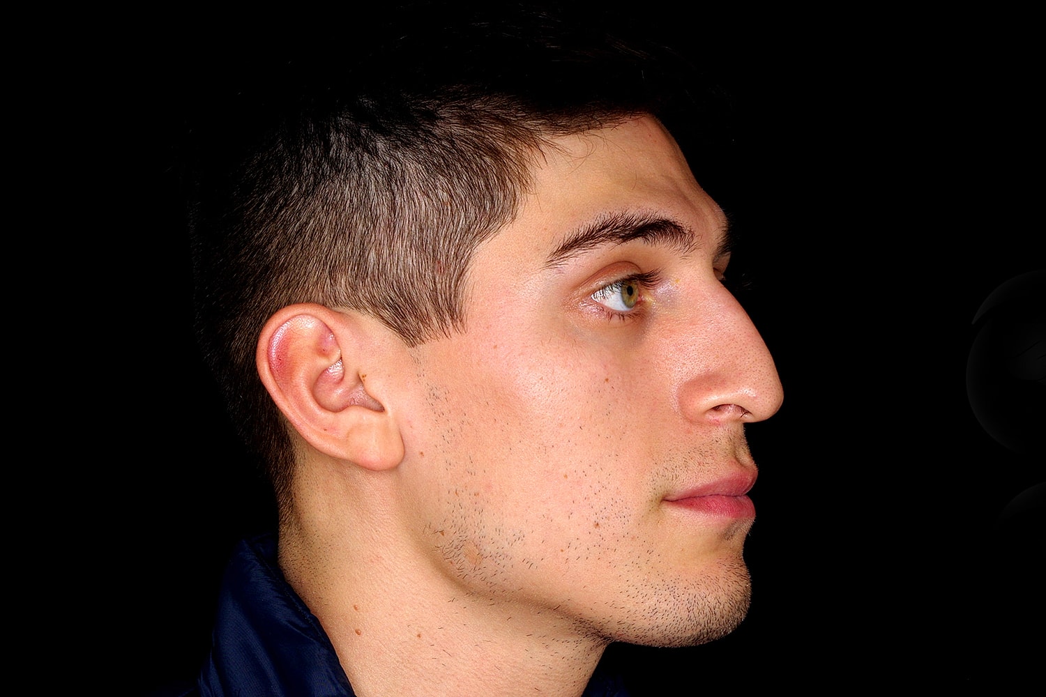 Rhinoplasty Before & After