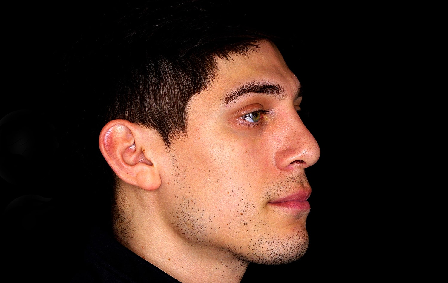 Rhinoplasty Before & After