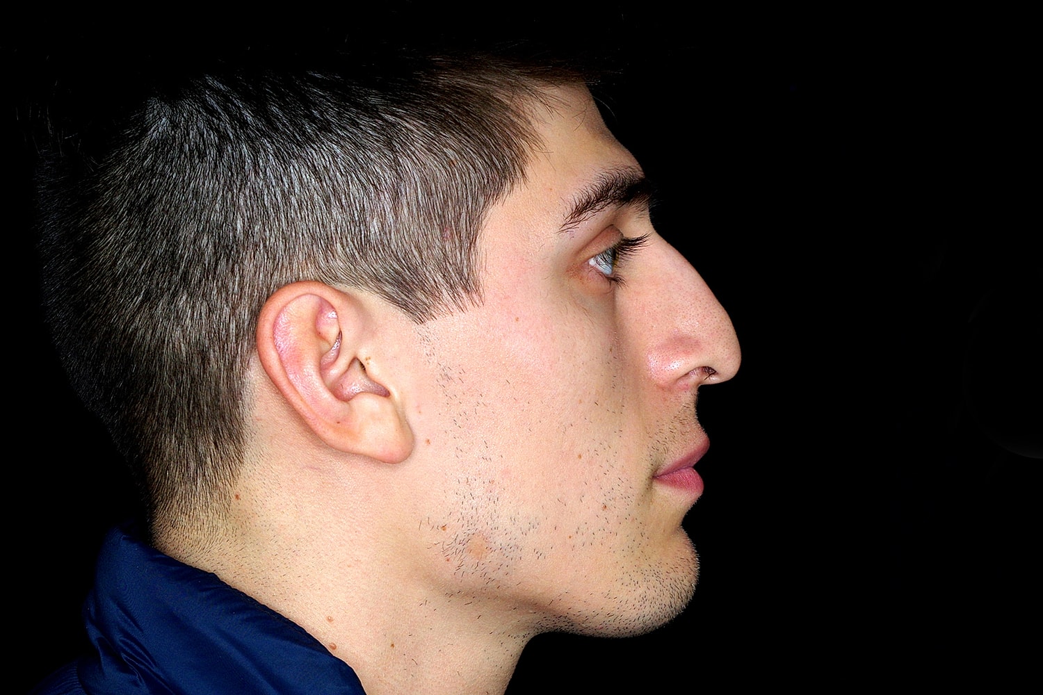 Rhinoplasty Before & After