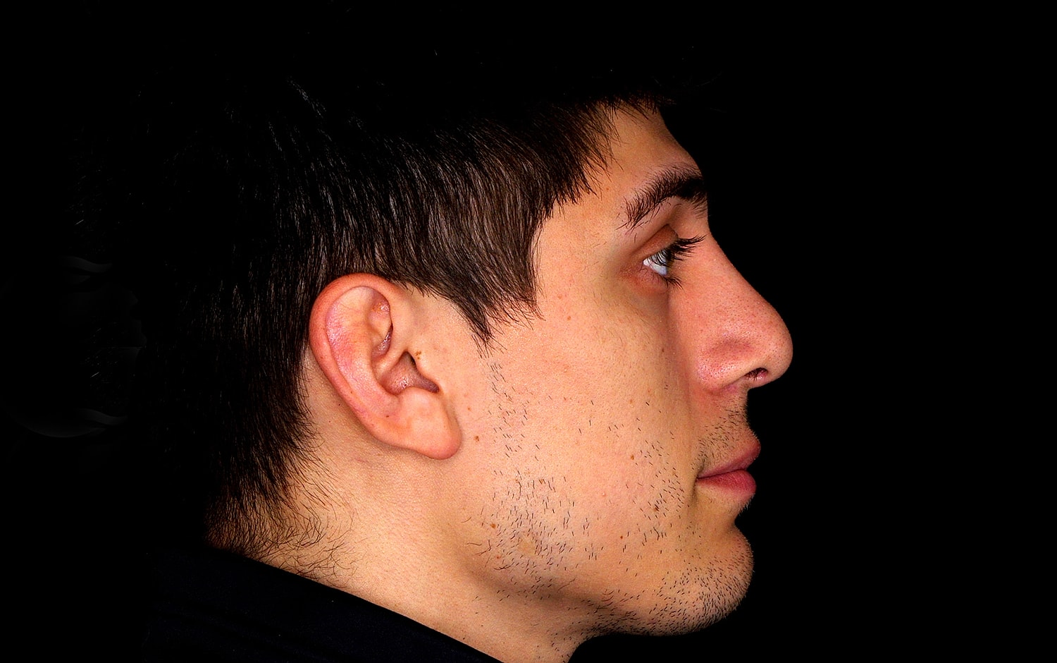 Rhinoplasty Before & After