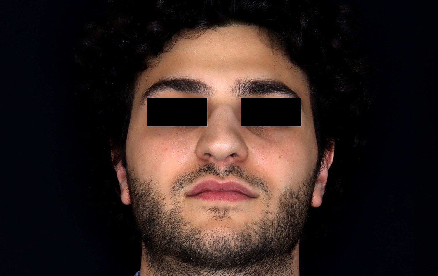 Rhinoplasty Before & After