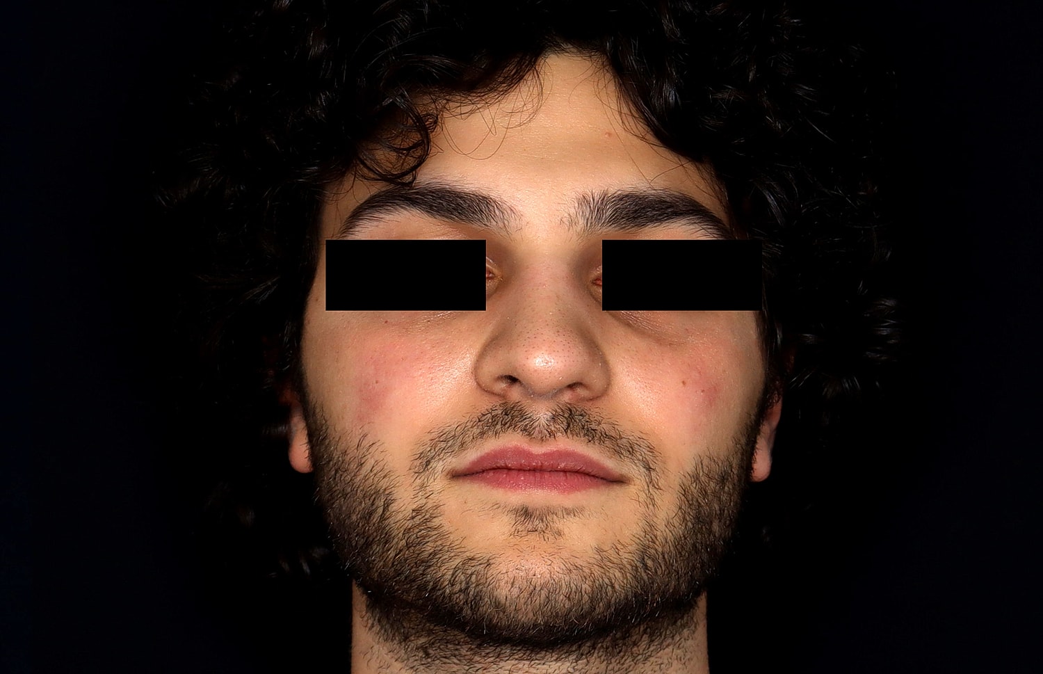 Rhinoplasty Before & After