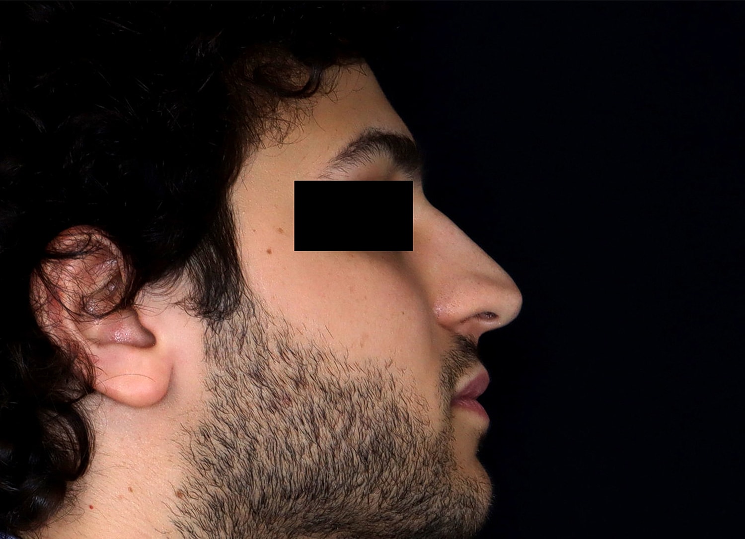 Rhinoplasty Before & After