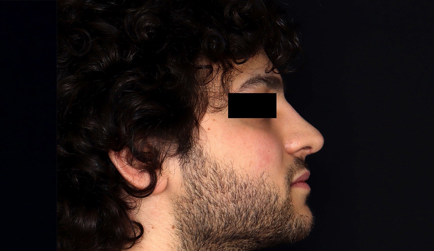 Rhinoplasty Before & After