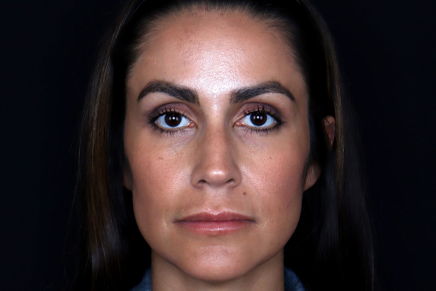 Rhinoplasty Before & After