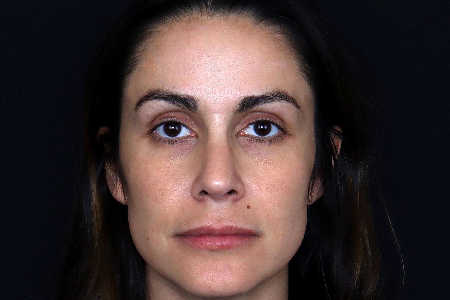 Rhinoplasty Before & After
