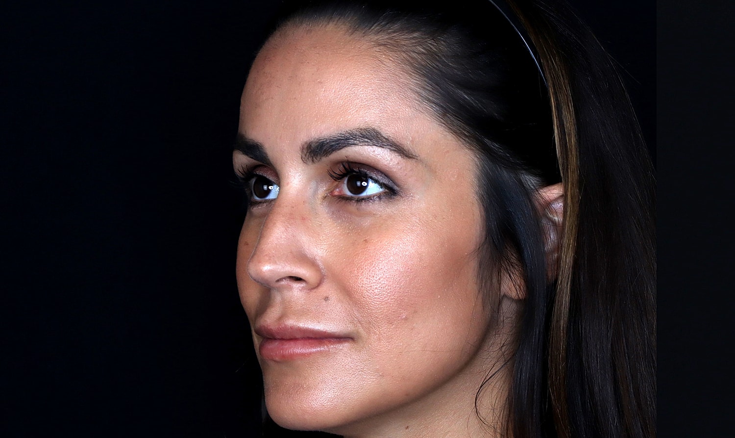 Rhinoplasty Before & After