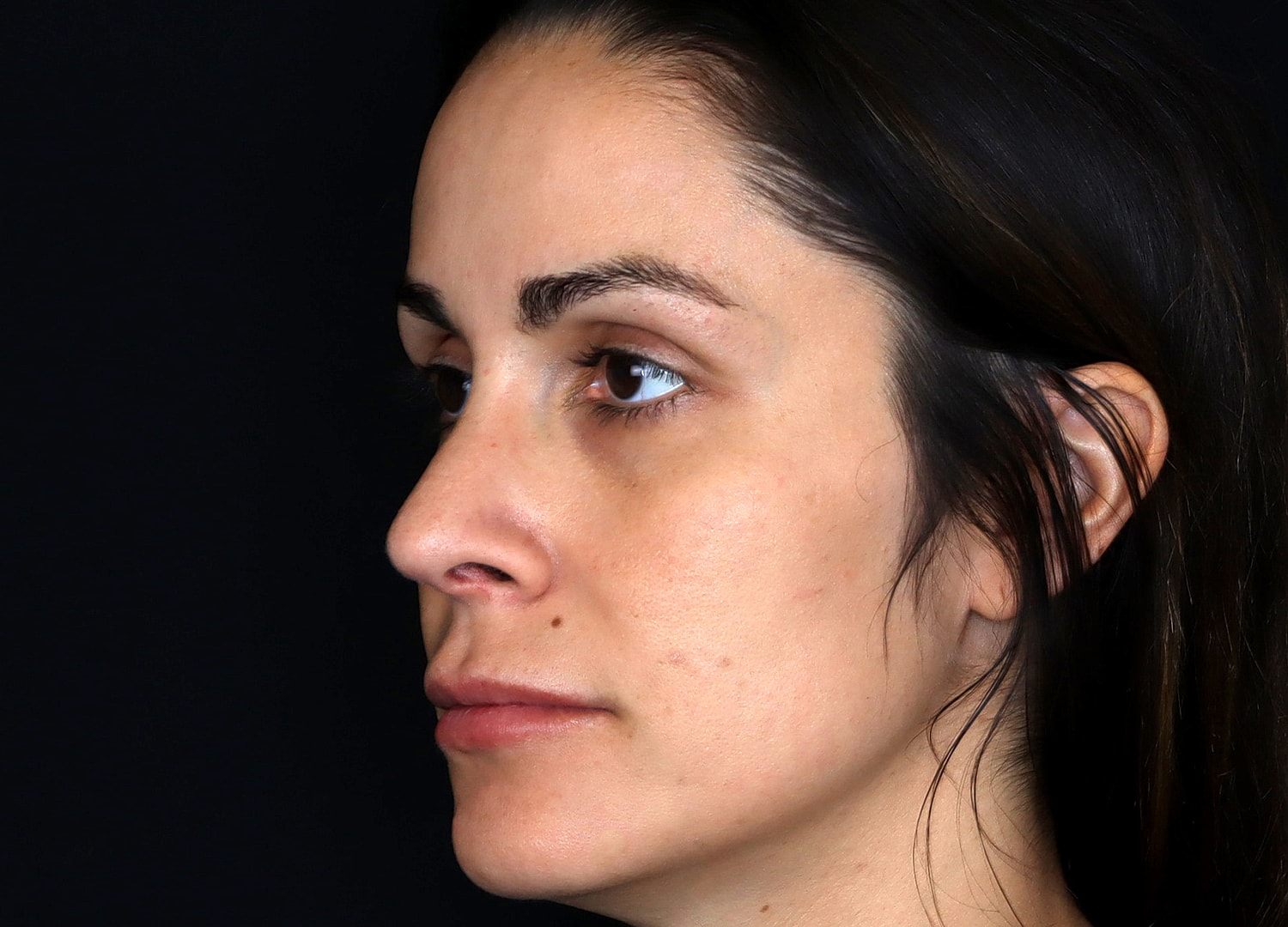 Rhinoplasty Before & After