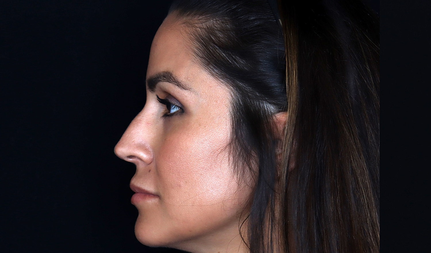 Rhinoplasty Before & After