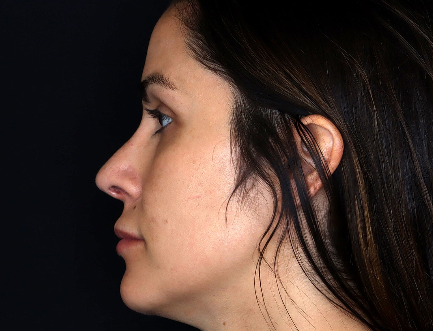 Rhinoplasty Before & After